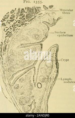 Der menschlichen Anatomie, einschließlich der Struktur und Entwicklung und praktische Erwägungen. Rior Oberfläche der Kehlkopf Rachen geöffnet von hinten; Kehldeckel drehte sich zurück. Bedeutet, dass der gesamte hintere Oberfläche des weichen Gaumens mit Ciliated colum-nar Zellen gekleidet ist, da die gesamte Zäpfchen und die Kanten der palato-pharyngealen Falten areinvested mit geschichteten Plattenepithel. Letzteres umfasst auch die posteriorwall des Pharynx und erstreckt sich über so weit wie das Gewölbe. Wenn coxered withciliated Epithel, die Schleimhaut ist Röter, dicker, und enthält moreglands, aber weniger Papillen, als in Tho Stockfoto