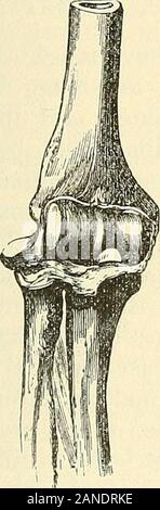 Eine praktische Abhandlung über Brüche und Verwerfungen. Ington, Lond. Hosp., Lancet, Dez. 27, 1879. 9 Beere, New York Med. Gaz., Vol. vii. Nr. 6, 24.02.7, 1880.10 Barros, Centralblatt Fell Chirurgie, 1886. Verwerfungen, DER LEITER DER RADIUS NACH HINTEN. 623 schien die Verschiebung notwendig zu sein. Streubel1 Überstreckung der Unterarm während supinated, mit gewaltsame Beugung nach oben und auf der radialen Seite. Cameron berichtet von einem Fall, in dem ein Mann hatte eine Verschiebung, die durch die eine Karre pressureof bei der Hand, während der Ellbogen gegen eine Wand ruhte. Diese variousconditions kann alle erklärt werden, Probabl Stockfoto