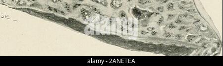 Erkrankungen der Brust und der Prinzipien der physischen Diagnose. .% ¥*.. t/-^V^... Abb. 300.-Retikuläre Fibrose. {Phipps Institut, Fünfter Bericht. Stockfoto