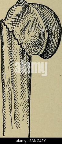 Atlas und Inbegriff von traumatischen Frakturen und Verrenkungen. Abb. 57.- Bruch der sur-gical Hals. Das obere Ende des unteren Fragment ist in-Bezirk verdrängt. Der Arm ist in Entführung.. Abb. 58.- Bruch der sur-gical Hals. Das obere Ende des theshaft verdrängt nach außen in den Knochen thearm andwedged; daher ist in adduktion. in seiner normalen Position unter dem Schulterdach. Die injuredarm ist entweder in Entführung oder in Adduktion, aber nottend auf seinen Standpunkt zurückzukehren, nachdem die reduzierende Kraft isremoved. In vielen Fällen ist die Verkürzung der Arm, ein Punkt der Unterscheidung von subcoracoid Luxation. Ein Stockfoto