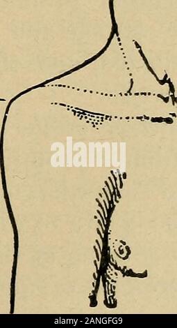 Atlas und Inbegriff von traumatischen Frakturen und Verrenkungen.-.. Abb. 51.- Fraktur der Hals Abb. 52.- Fraktur der Hals der Scapula. Mai des humerus mit dem Arm in kombiniert werden mit Untergang der Schulter wenn Entführung, den Oberarm gelähmt ist. achselhöhle. Passive Bewegung ist äußerst schmerzhaft andlimited; aktive Bewegungen sind noch mehr eingeschränkt. 10 146 Frakturen und Verrenkungen. Unter den Zubehör Verletzungen sind Trennung der plattedes Knochen am grösseren tuberosity; selten Verletzungen andie Schiffe; häufiger Verletzungen der Nerven. Expos Thenerves in dieser Verschiebung sind immer Stockfoto