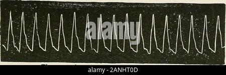 Erkrankungen der Brust und der Prinzipien der physischen Diagnose. Die bigeminal Impuls (digitaliseffekt in Congelador Vorhofflimmern ion). Das Wasser - Hammer Impuls (aorteninsuffizienz) Stockfoto