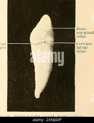 Grundsätze und Praxis der Operative Zahnheilkunde. Abb. 31.-inferioren rechten Eckzahn, mesialen Oberfläche. (vergrößert). -Inferioren rechten Eckzahn, distalen Oberfläche. (vergrößert.) KLASSIFIZIERUNG UND BESCHREIBENDEN ANATOMIE DER ZÄHNE. 11 Die cervix auf Abschnitt präsentiert eine abgeflachte Oval. Die Emaille linemaintains über die gleiche Gliederung wie in der zentralen Schneidezähne, curvingupward auf der labialen und mehrsprachige Oberflächen, und unten auf themesial und distalen. Gelegentlich stellt es eine leichte Depressionen bothmesially und distalen^, die auf dem root als Nut fortgesetzt werden kann. Die Wurzel ist der längste aller menschlichen Zähnen Stockfoto