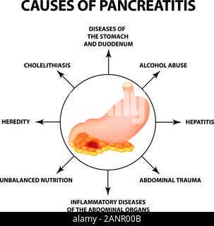 Ursachen einer Pankreatitis. Die Struktur des Magens und der Bauchspeicheldrüse. Infografiken. Vector Illustration auf isolierte Hintergrund Stock Vektor