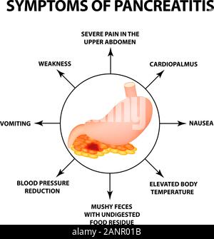 Symptome einer Pankreatitis. Die Struktur des Magens und der Bauchspeicheldrüse. Infografiken. Vector Illustration auf isolierte Hintergrund Stock Vektor