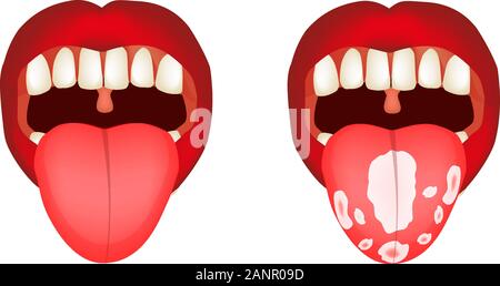 Candidose der Zunge, Soor. Entzündung der Zunge. Infografiken. Vector Illustration auf isolierte Hintergrund. Stock Vektor