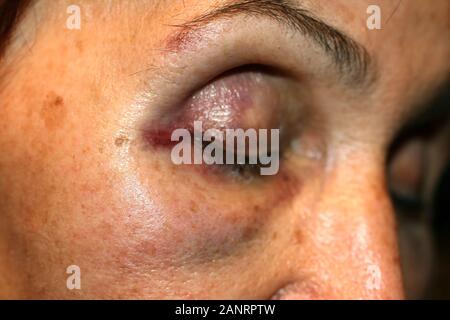 Ein blauer Fleck in der Nähe des Auges. Hämatome im Gesicht bei einem Schlag. Augenverletzungen. Stockfoto