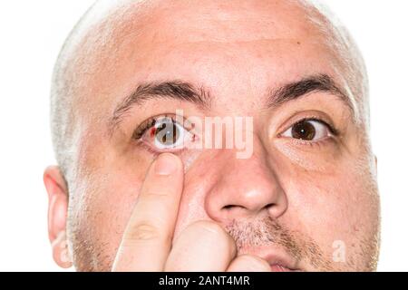 Augenverletzungen, junger Mann mit Platzen von Blutgefäßen im Auge, Ermüdung, Probleme mit den Blutgefäßen Stockfoto