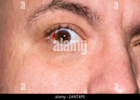 Augenverletzungen, junger Mann mit Platzen von Blutgefäßen im Auge, Ermüdung, Probleme mit den Blutgefäßen Stockfoto