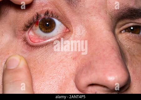 Augenverletzungen, junger Mann mit Platzen von Blutgefäßen im Auge, Ermüdung, Probleme mit den Blutgefäßen Stockfoto