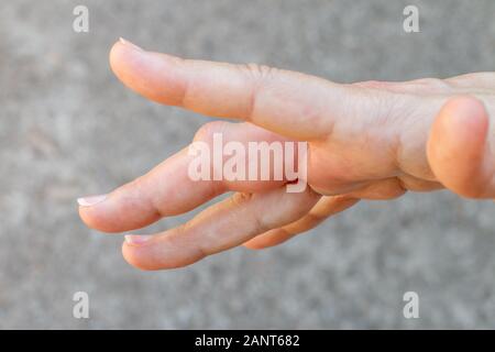 Eine mit der rechten Hand mit einer Biene, Wespe Bissenmarkierung, geschwollene Finger, Hand nach einer Biene Biss Stockfoto