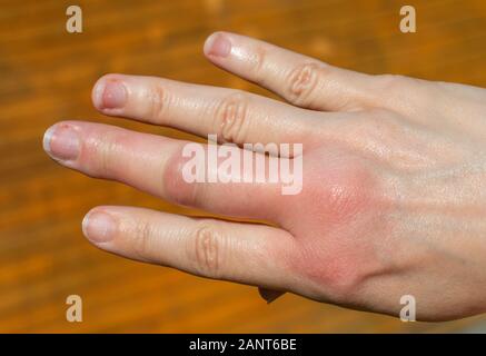 Eine rechte Hand nach einer Biene biss auf einer hölzernen Hintergrund, Schwellung der Hand, geschwollene Finger, Hand nach einem Bienenstich Stockfoto