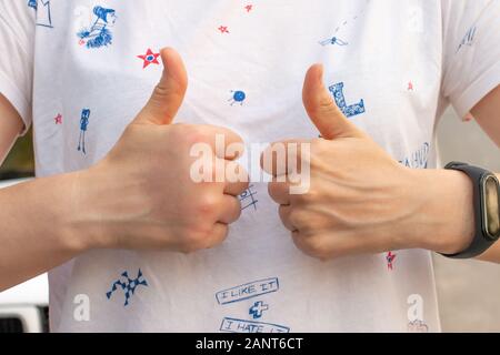 Vergleich von einem normalen Linken zu einem Rechten mit einer geschwollenen Palm nach einer Biene beißen, wespenstich auf einem t-shirt Hintergrund Stockfoto