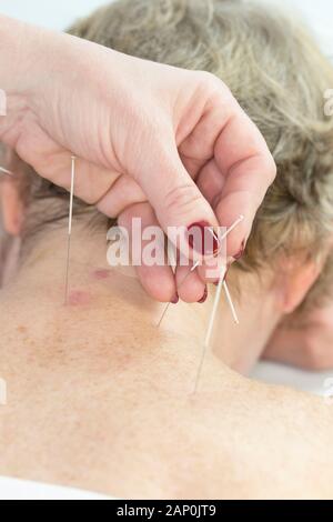 Ältere Frauen, die sich in einem Spa einer Akupunktur unterziehen. Stockfoto