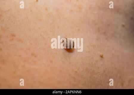 Papillom auf der Haut des Halses einer Frau. Weicher Fokus, geringe Schärfentiefe. Stockfoto