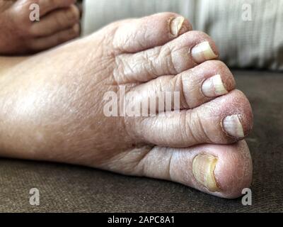 Füße eines Patienten, der wegen Pilzes und Athleten ein Lungenödem mit beschädigten Nägeln hat Stockfoto