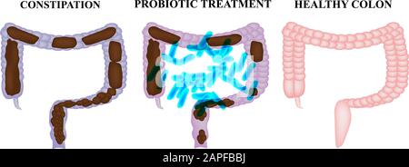 Behandlung von Verstopfung mit Probiotika. Lactobacillus. Kot im Dickdarm. Infografiken. Vektordarstellung auf isoliertem Hintergrund. Stock Vektor