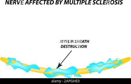 Die Zerstörung der Myelinhülle am Axon. Beschädigtes Myelin. Neuron, das von Multipler Sklerose betroffen ist. Tag Der Multiplen Sklerose Der Welt. Infografiken Stock Vektor