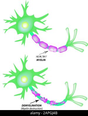 Die Zerstörung der Myelinhülle am Axon. Beschädigtes Myelin. Neuron, das von Multipler Sklerose betroffen ist. Tag Der Multiplen Sklerose Der Welt. Infografiken Stock Vektor