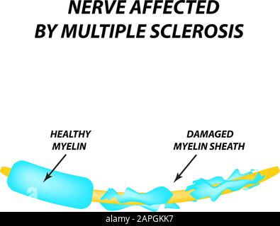 Die Zerstörung der Myelinhülle am Axon. Beschädigtes Myelin. Neuron, das von Multipler Sklerose betroffen ist. Tag Der Multiplen Sklerose Der Welt. Infografiken Stock Vektor