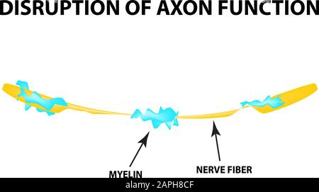 Die Zerstörung der Myelinhülle am Axon. Beschädigtes Myelin. Neuron, das von Multipler Sklerose betroffen ist. Tag Der Multiplen Sklerose Der Welt. Infografiken Stock Vektor