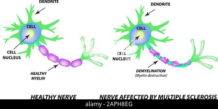 Die Zerstörung der Myelinhülle am Axon. Beschädigtes Myelin. Neuron, das von Multipler Sklerose betroffen ist. Tag Der Multiplen Sklerose Der Welt. Infografiken Stock Vektor