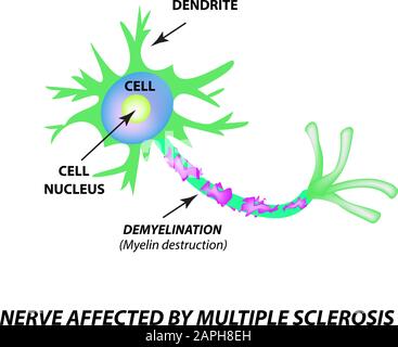 Die Zerstörung der Myelinhülle am Axon. Beschädigtes Myelin. Neuron, das von Multipler Sklerose betroffen ist. Tag Der Multiplen Sklerose Der Welt. Infografiken Stock Vektor