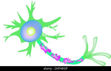 Die Zerstörung der Myelinhülle am Axon. Beschädigtes Myelin. Neuron, das von Multipler Sklerose betroffen ist. Tag Der Multiplen Sklerose Der Welt. Infografiken Stock Vektor