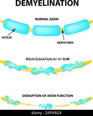 Die Zerstörung der Myelinhülle am Axon. Beschädigtes Myelin. Neuron, das von Multipler Sklerose betroffen ist. Tag Der Multiplen Sklerose Der Welt. Infografiken Stock Vektor