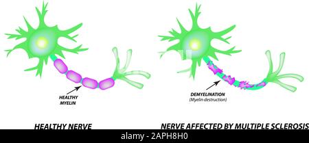 Die Zerstörung der Myelinhülle am Axon. Beschädigtes Myelin. Neuron, das von Multipler Sklerose betroffen ist. Tag Der Multiplen Sklerose Der Welt. Infografiken Stock Vektor