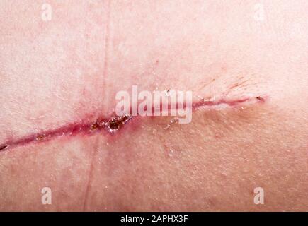 Eine Naht nach einer Operation an der Haut des Rückens einer Person. Chirurgische Transplantation einer Muskelklappe von hinten. Genähte, selbst saugbare Wunden, Stockfoto