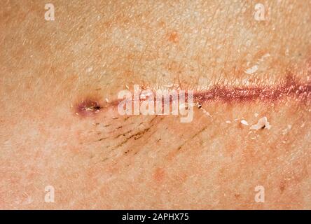 Eine Naht nach einer Operation an der Haut des Rückens einer Person. Chirurgische Transplantation einer Muskelklappe von hinten. Genähte, selbst saugbare Wunden, Stockfoto