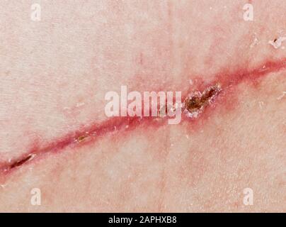 Eine Naht nach einer Operation an der Haut des Rückens einer Person. Chirurgische Transplantation einer Muskelklappe von hinten. Genähte, selbst saugbare Wunden, Stockfoto