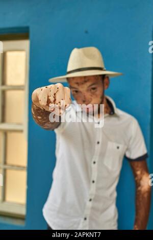 Porträt des jungen Mannes mit Vitiligo, der einen Hut trägt Stockfoto