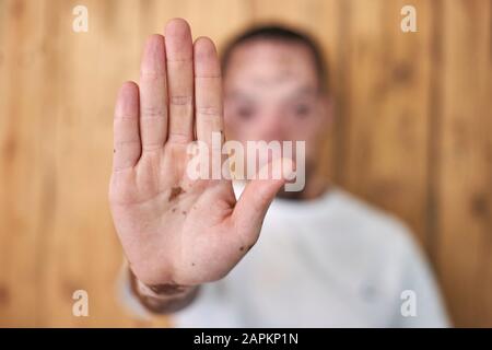 Nahaufnahme der Hand eines Mannes mit Vitiligo Stockfoto