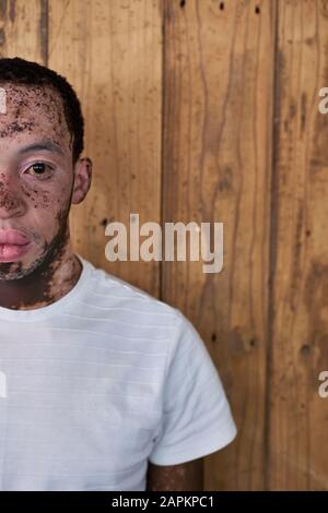 Halbporträt eines jungen Mannes mit Vitiligo vor einer Holzwand Stockfoto