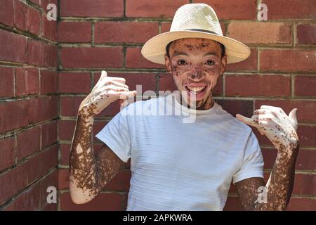 Porträt des jungen Mannes mit Vitiligo, der einen Hut trägt und das Surferzeichen macht Stockfoto