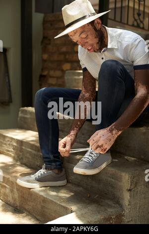 Porträt des jungen Mannes mit Vitiligo, der einen Hut trägt und seine Schuhe auf der Treppe sitzend bindet Stockfoto
