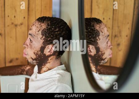 Junger Mann mit Vitiligo und seiner Spiegelung im Spiegel Stockfoto