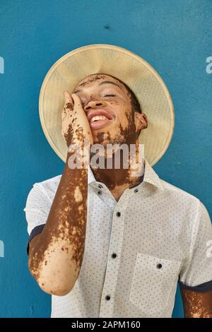 Porträt des jungen Mannes mit Vitiligo, der einen Hut trägt, Hand im Gesicht Stockfoto