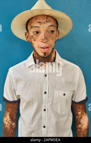 Porträt des jungen Mannes mit Vitiligo, der einen Hut trägt, blaue Wand im Hintergrund Stockfoto