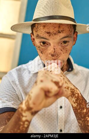 Porträt des jungen Mannes mit Vitiligo, der einen Hut trägt und seine Faust zeigt Stockfoto