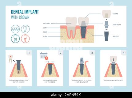 Medizinisches Verfahren und Struktur des Zahnimplantats, Zahnmedizin und Kieferorthopädische Konzepte Stock Vektor