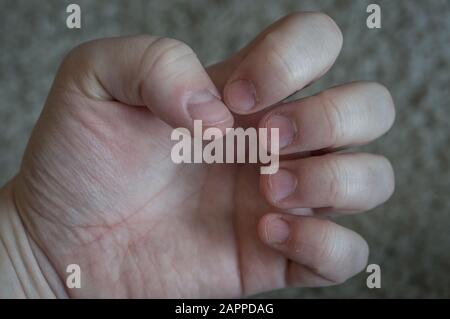 Geschädigte Nägel an Hand durch Beißungs- und Dermatillomanie/zwanghafte Hautpflückstörung langfristig. Zerrissene Cuticles. Konpekte von Stress, Angst, Depressi Stockfoto