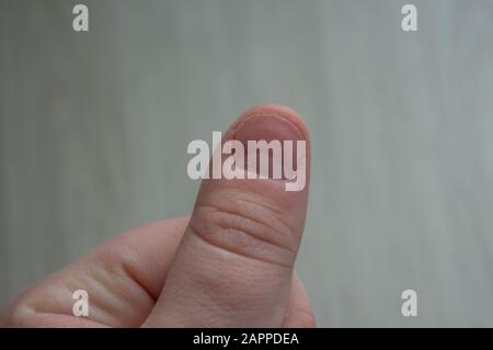 Beschädigte Miniatur mit zerrissenen Cuticles und Bläschen. Zustand durch zwanghaftes, obligatorisches Hautpflücken und Nagelbeißen. Konzept des Stresses, a Stockfoto