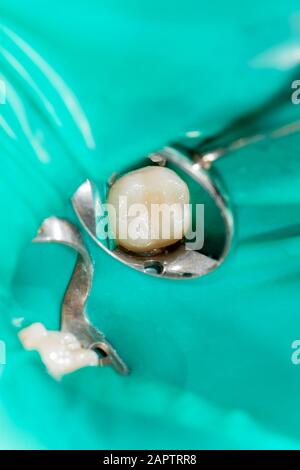 Karies. Befüllen mit zahnmedizinischen Composite photopolymer Material mit rabbders. Das Konzept der zahnärztlichen Behandlung in einer Zahnklinik Stockfoto