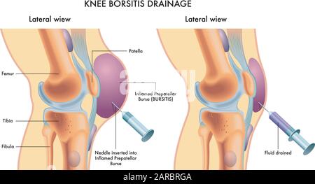 Beschriftete medizinische Abbildung zeigt das Verfahren zur Entwässerung der Kniebursitis. Stock Vektor