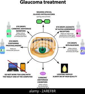 Glaukombehandlung. Augentropfen. Weltglaukomtag. Die anatomische Struktur des Auges. Infografiken. Vektordarstellung auf isoliertem Hintergrund. Stock Vektor