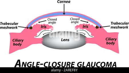 Geschlossenes Winkelglaukom. Eine häufige Art von Glaukom. Die anatomische Struktur des Auges. Infografiken. Vektordarstellung auf isoliertem Hintergrund. Stock Vektor