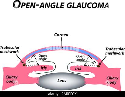 Offenes Glaukom. Eine häufige Art von Glaukom. Die anatomische Struktur des Auges. Infografiken. Vektordarstellung auf isoliertem Hintergrund. Stock Vektor